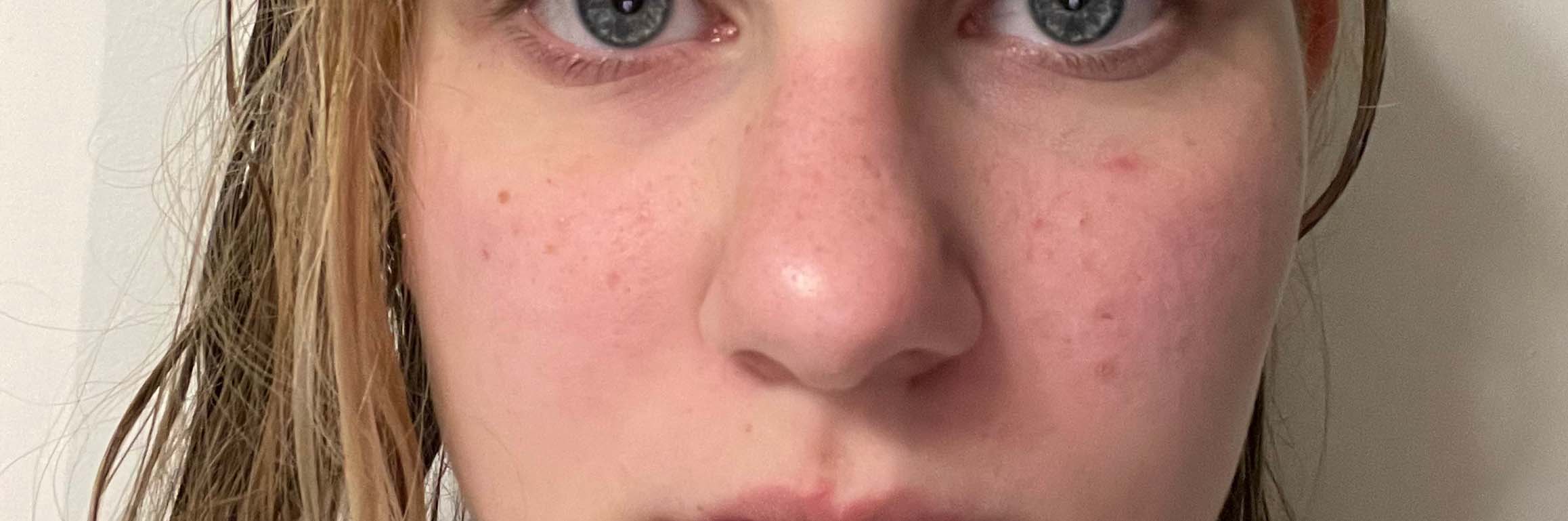 Acne SUCKS